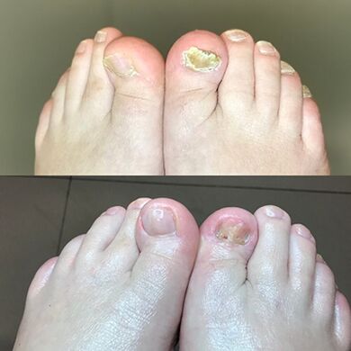 Erfahrung in der Verwendung von Crema Barnabas, die Israel vor und nach