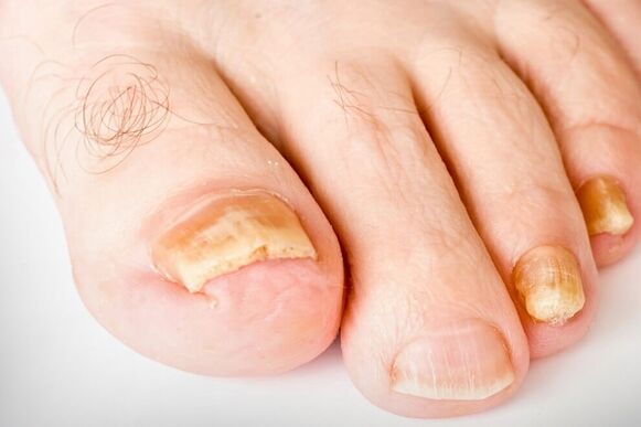 Die dritte Phase des Hirb -Nagels