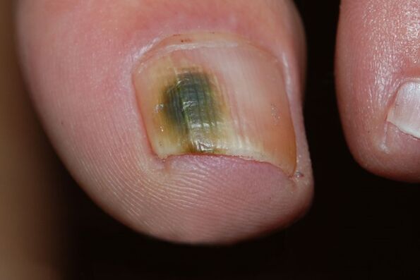 schimmelige Art von Nagelpilzen