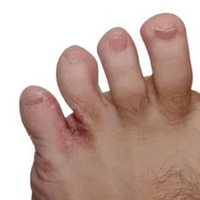 Pilze zwischen den Fingern