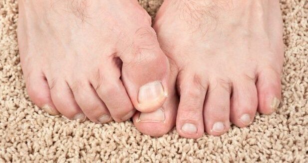 Symptome von Nagelpilzen