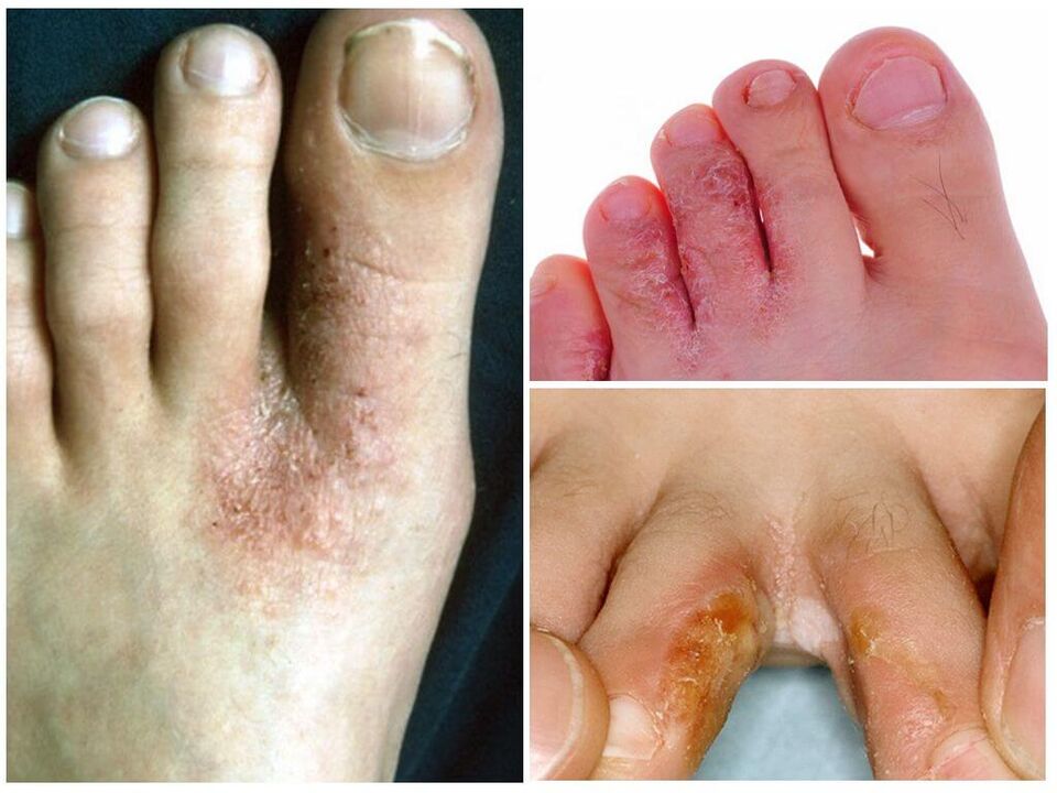Interdigitalmykose