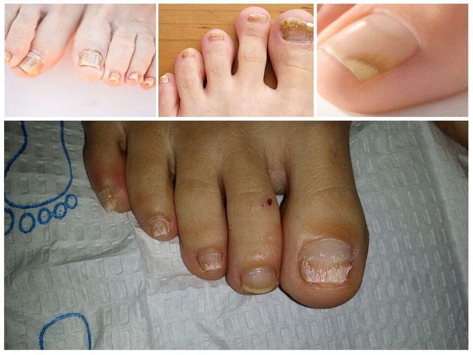 Nagelpilzerkrankungen