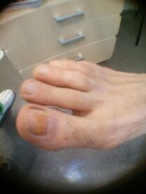 Frühstadium eines Zehennagelpilzes