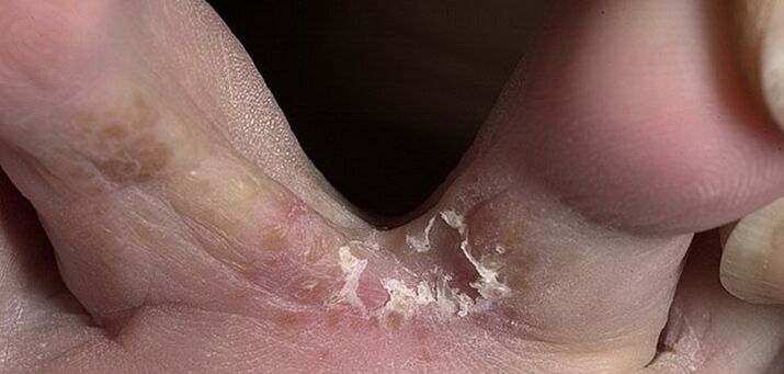 Pilz zwischen den Zehen