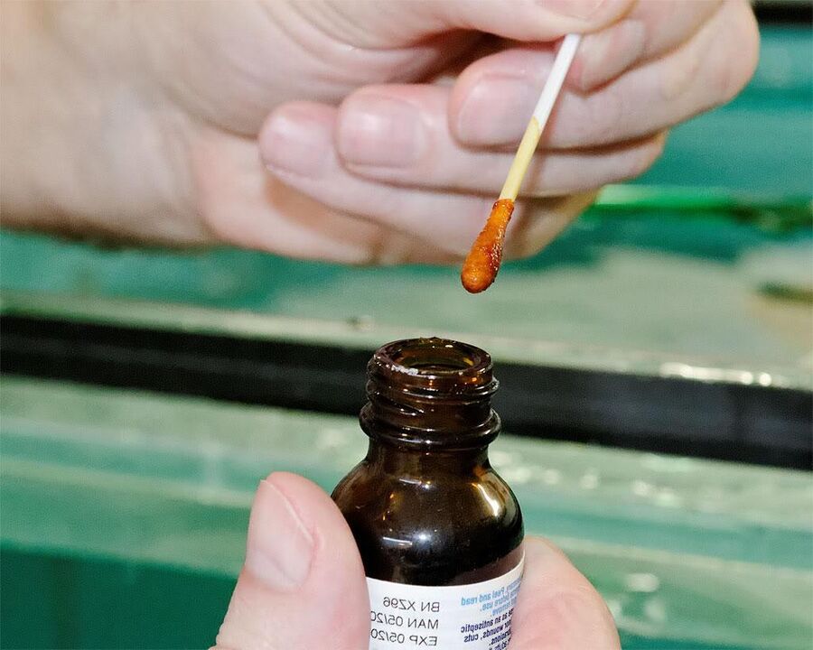 Wenn Sie eine Mischung aus Jod und Schöllkrautsaft auf Ihre Zehennägel auftragen, wird der Pilz beseitigt